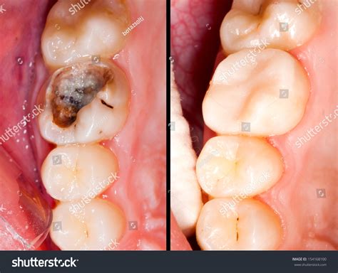 Decayed Tooth Before After Restorative Treatment Stock Photo 154168100 ...