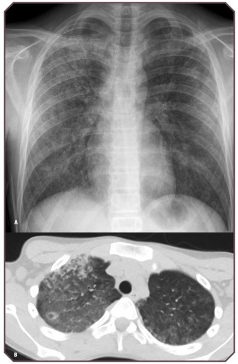 Vasculitis-Related Respiratory Disorders | Obgyn Key