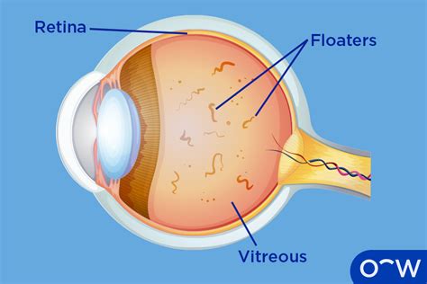 Eye Floaters: Definition, Causes, Symptoms, and Treatment