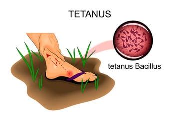 Tetanus Causes, Symptoms, Prevention, and Treatment Healthsoothe ...