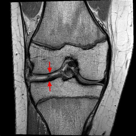 How To Read Knee Mri Knee Mri Meniscus Tear Mri | Images and Photos finder