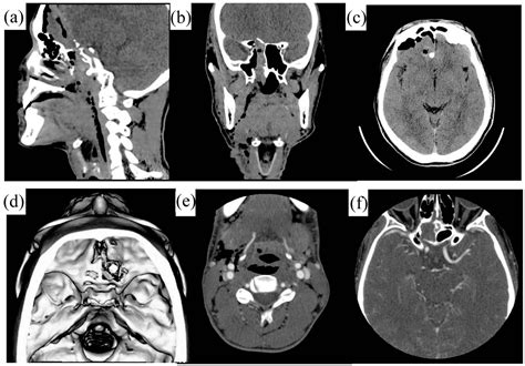 CT scan of Base of Skull – Video Lecture | Dentistry & Medicine