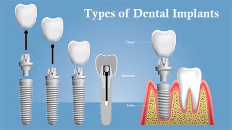 WHAT ARE THE MAJOR TYPES OF DENTAL IMPLANTS AVAILABLE?