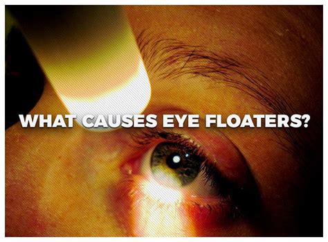 What Causes Eye Floaters?