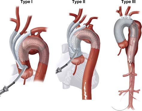 Figure 2 from Hybrid repair of aortic arch aneurysms: combined open ...