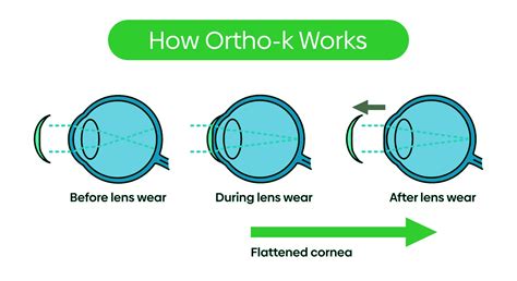 Orthokeratology Lenses – A Comprehensive Guide to Overnight Vision ...