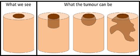 Examples of what could be the tumour when it is not possible to see ...