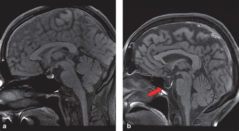 Empty sella syndrome causes, risk factors, symptoms, diagnosis & treatment