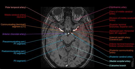 Posterior Cerebral Artery Mri