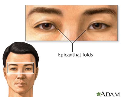 Epicanthal folds Information | Mount Sinai - New York