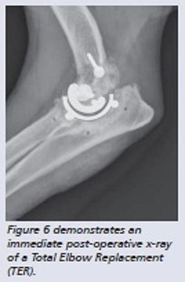 The Elbow: Treatment of Canine Elbow Dysplasia - Veterinary Surgical ...