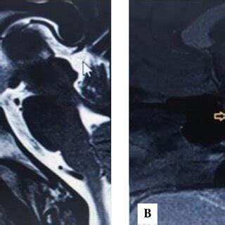 MRI Brain -Yellow arrow showing empty sella (A) T2 weighted, (B) T1 ...