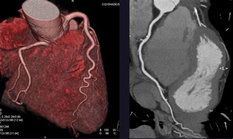 24 HEART TEST ANGIOGRAPHY - TestHeart