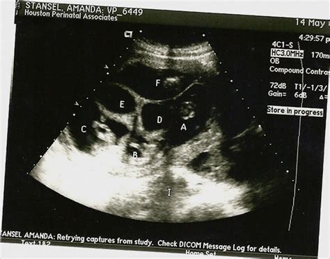 Ultrasound Quintuplets