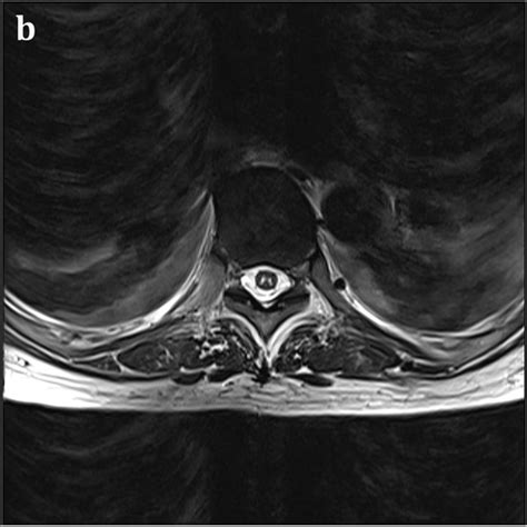 Thoracic spinal cord MRI. Sagittal T1-weighted MRI shows signal ...