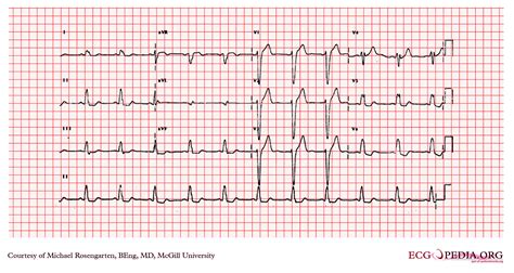 Left bundle branch block electrocardiogram - wikidoc