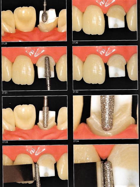 Anterior Crown Preparation | Dental Esthetics