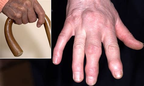 Sausage fingers to knobbly knuckles: The causes of hand pain - and how ...