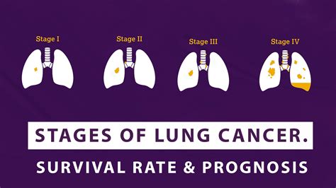 Stages Of Lung Cancer – Survival Rate And Prognosis - Macs Blogs