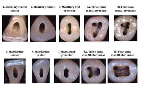 Access Cavity Preparation. | Dentistry, Dental, Dental hygiene school