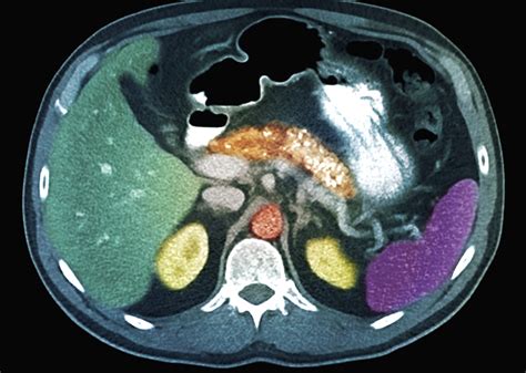 Chronic Pancreatitis: Challenging to Diagnose, Difficult to Treat ...