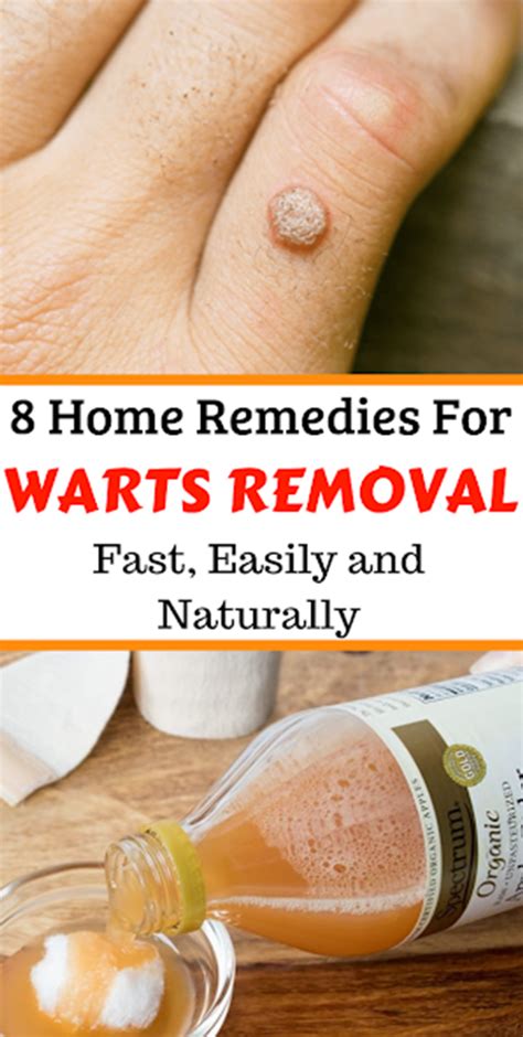 8 Home Remedies For Warts Removal Fast, Easily and Naturally | Home ...