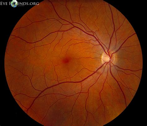 Atlas Entry - Normal fundus - adult