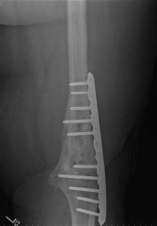 Knee Arthrodesis - Recon - Orthobullets