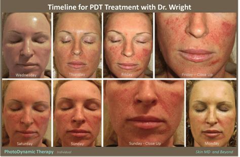 Photodynamic Therapy Plano, TX | PDT Frisco, TX | Acne Treatment