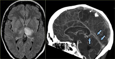 Cavernous Sinus Thrombosis Mrv