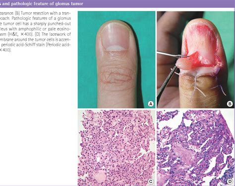 Figure 4 from Glomus Tumor of the Hand | Semantic Scholar