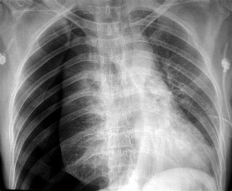 Tension pneumothorax and the “forbidden CXR” | Emergency Medicine Journal