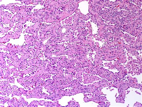 Lung Carcinoma Histology