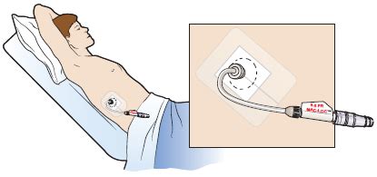 When To Remove Jp Drain After Cholecystectomy - HOWTORMEOV