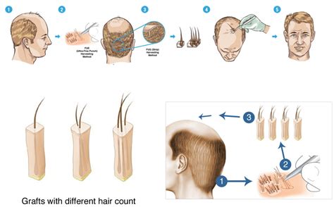 FUE (Follicle Unit Excision) | HSW Clinic | Dr. André Nel