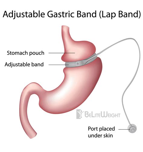 Adjustable, Laparoscopic Gastric Banding | Lap Band Procedures ...