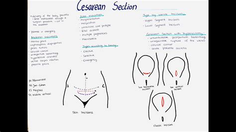 Cesarean Section Incision Types