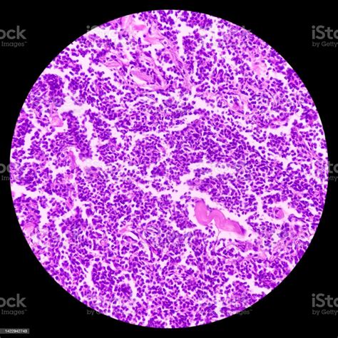 Supraclavicular Lymph Node Biopsy Microscopic Image Showing Benign ...