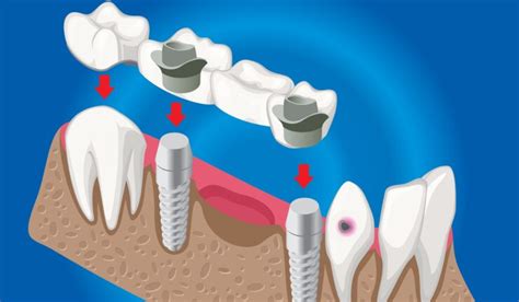 A Guide to Safe Dental Cement Removal