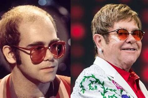 Unbelievable? 10 Celebrities Who Have Had Hair Transplants