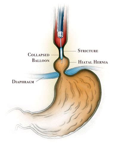 Peptic Esophageal Stricture | Memorial Hermann