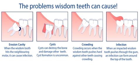 How Wisdom Teeth Are Removed – Wisdom Teeth Removal