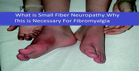 Small Fiber Neuropathy in Fibromyalgia and CFS - Fibromyalgia Resources