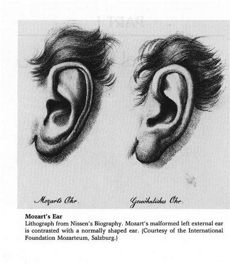 Mozart's ear, left. A very rare malformation. Music Nerd, Music Love ...