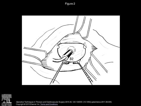 Mitral Annuloplasty Using A Biodegradable Annuloplasty Ring - ppt download