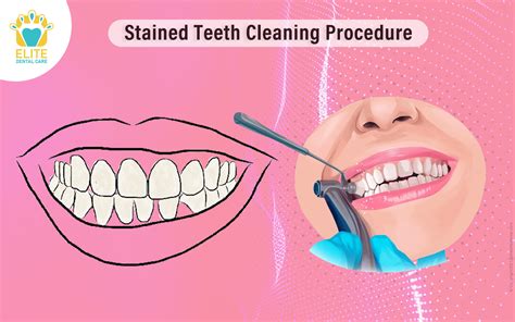 Stained Teeth Cleaning Procedure - Elite Dental Care