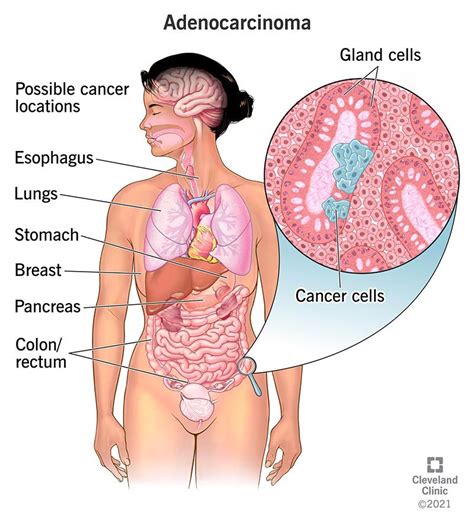 Intestine Cancer Symptoms Male