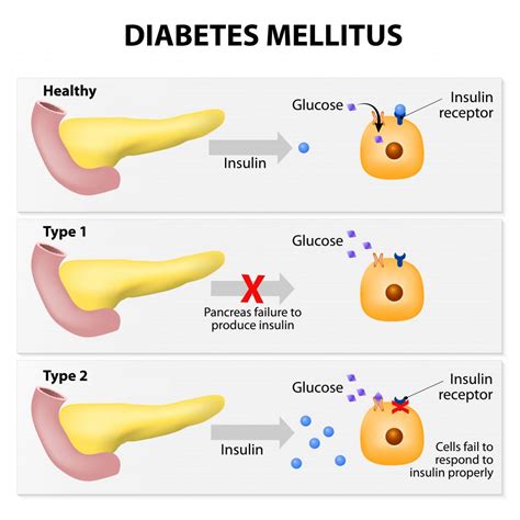 DIABETES MELLITUS. La diabetes mellitus se refiere a un… | by ...