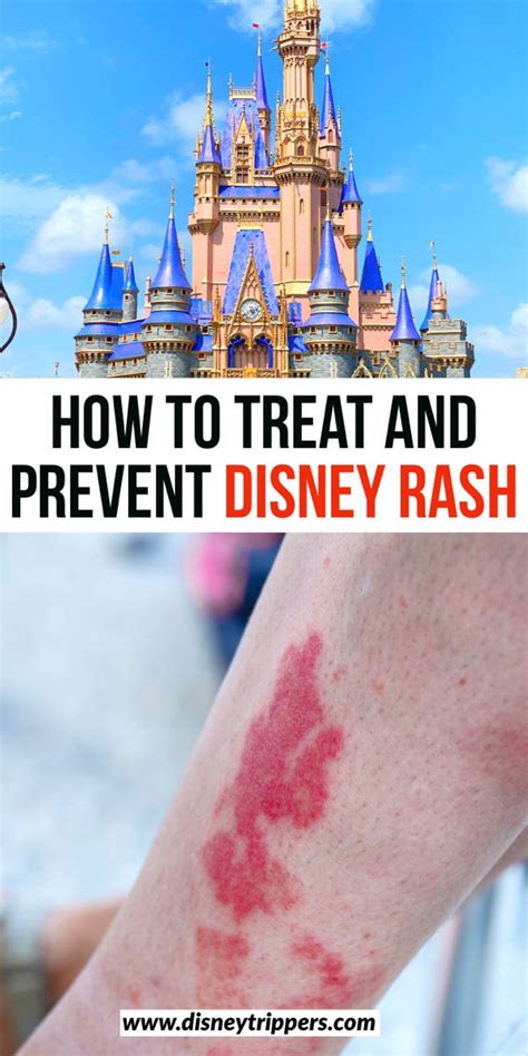 How To Treat And Prevent Disney Rash - Disney Trippers | Disney rash ...