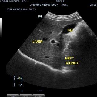 Ultrasound image of the epigastric region in longitudinal plane. This ...